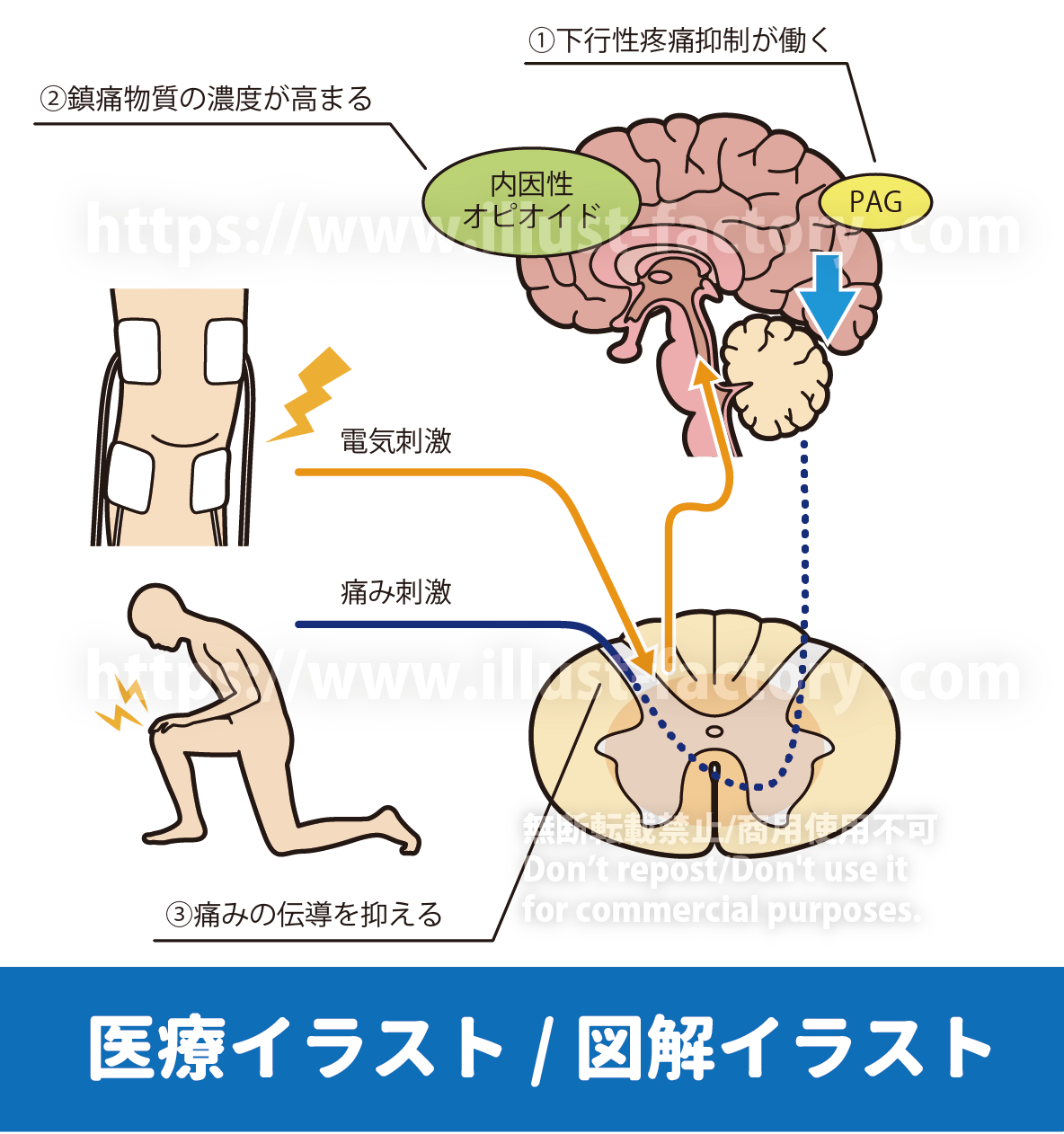 メディカルイラスト/医療イラスト/イラスト制作人体イラスト/論文用図解イラスト