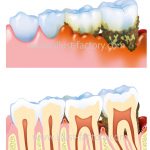 歯周病イラスト★リアル立体タッチ★医療系イラスト