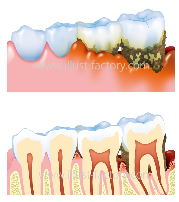 歯周病イラスト リアル立体タッチ 医療系イラスト お仕事紹介 質問解決ブログ イラスト制作の株式会社アット