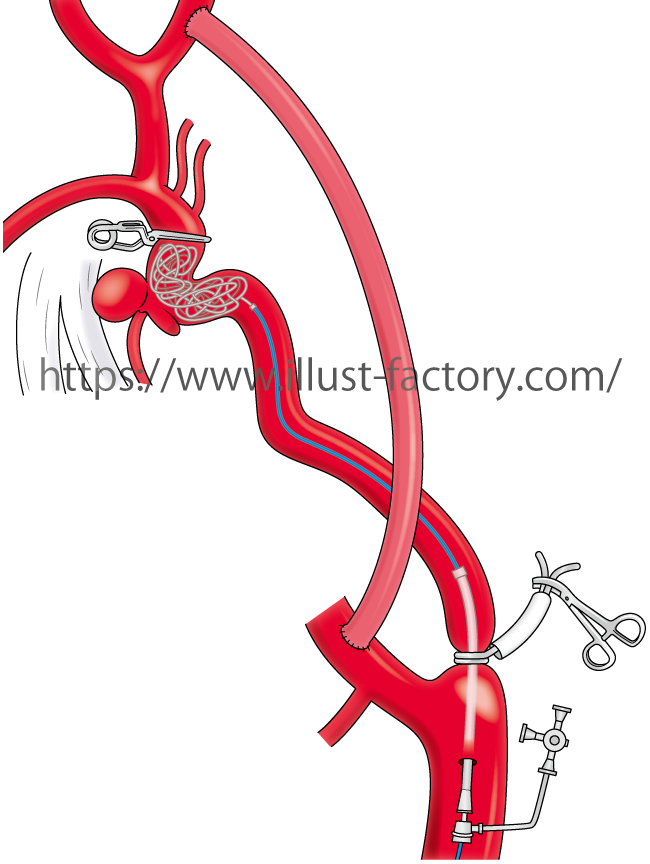 論文用の医療系イラスト 血管の図解 お仕事紹介 質問解決ブログ イラスト制作の株式会社アット