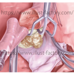 心臓外科論文投稿用イラスト　手書きリアルタッチ　H196