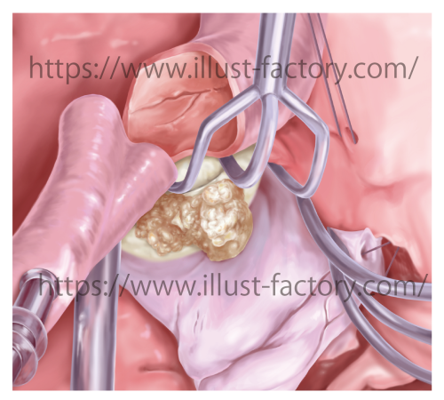心臓外科論文投稿用イラスト　手書きリアルタッチ　H196