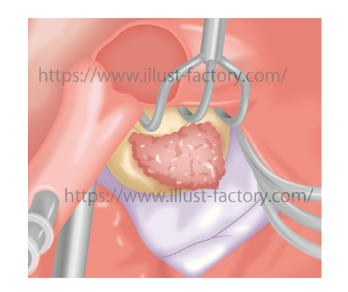 心臓外科論文投稿用イラストH95
