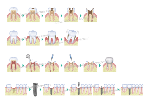 歯科の治療工程イラスト　H228