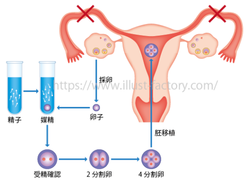 不妊治療子宮イラスト　H232