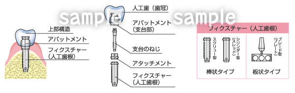 A46-14 歯科　インプラントの図解