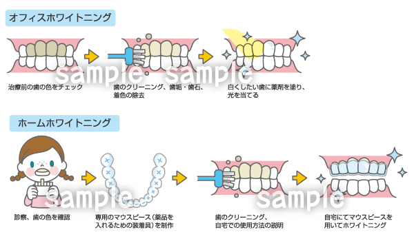 虫歯 ホワイトニング インプラント等の治療説明イラスト制作例 6 イラスト工房