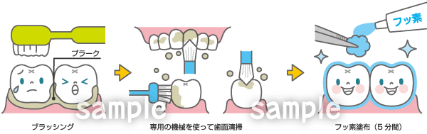 A46-06 歯科　フッ素塗布