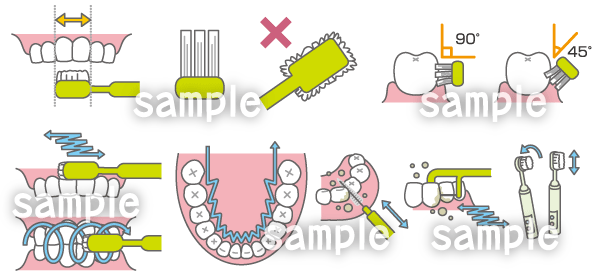 虫歯 ホワイトニング インプラント等の治療説明イラスト制作例 6 イラスト工房