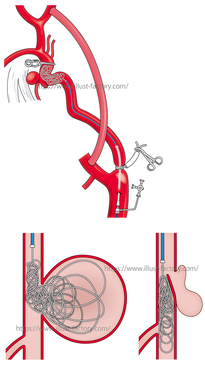 線画 医療論文用血管のイラスト制作 H81 イラスト工房