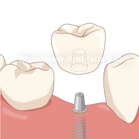 インプラントの手順GIFアニメ動画　H213